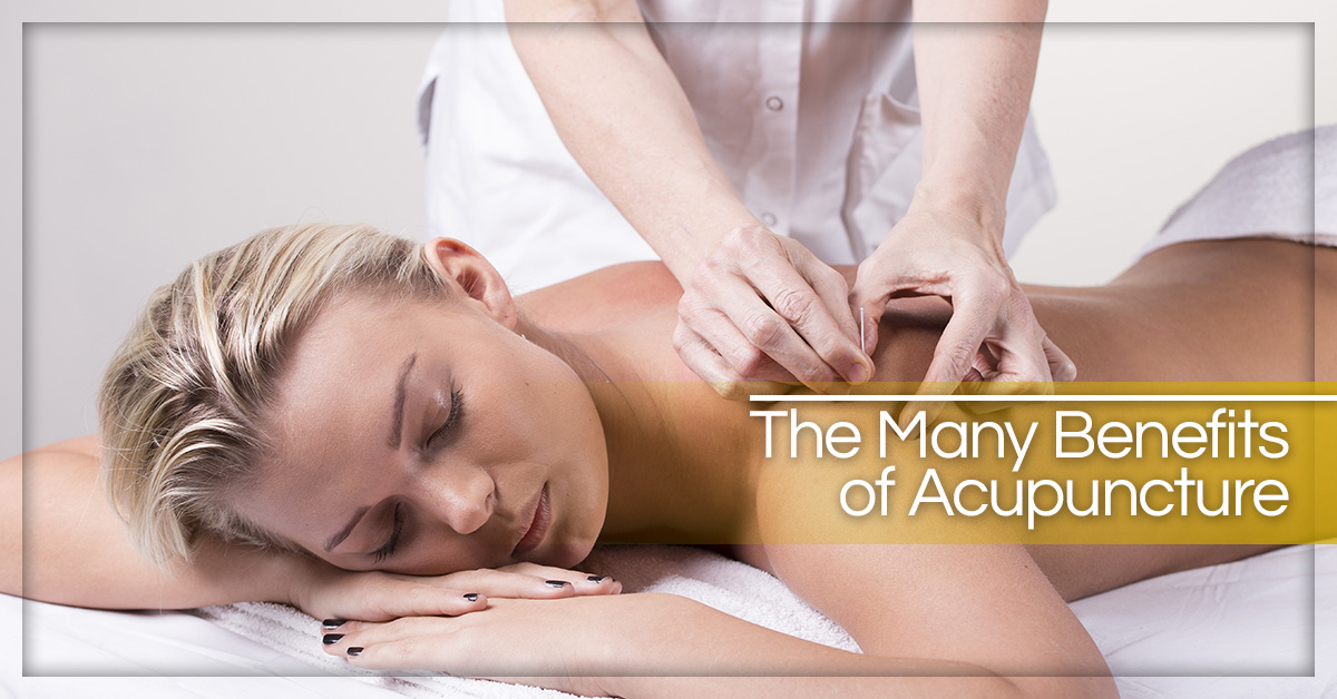 The-Many-Benefits-of-Acupuncture-58f789387d3de