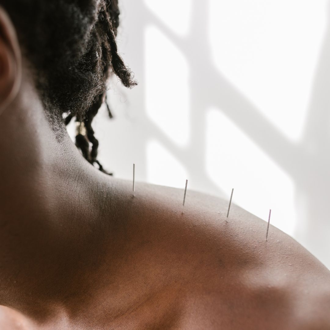 Person with four acupuncture needles going down their neck. 