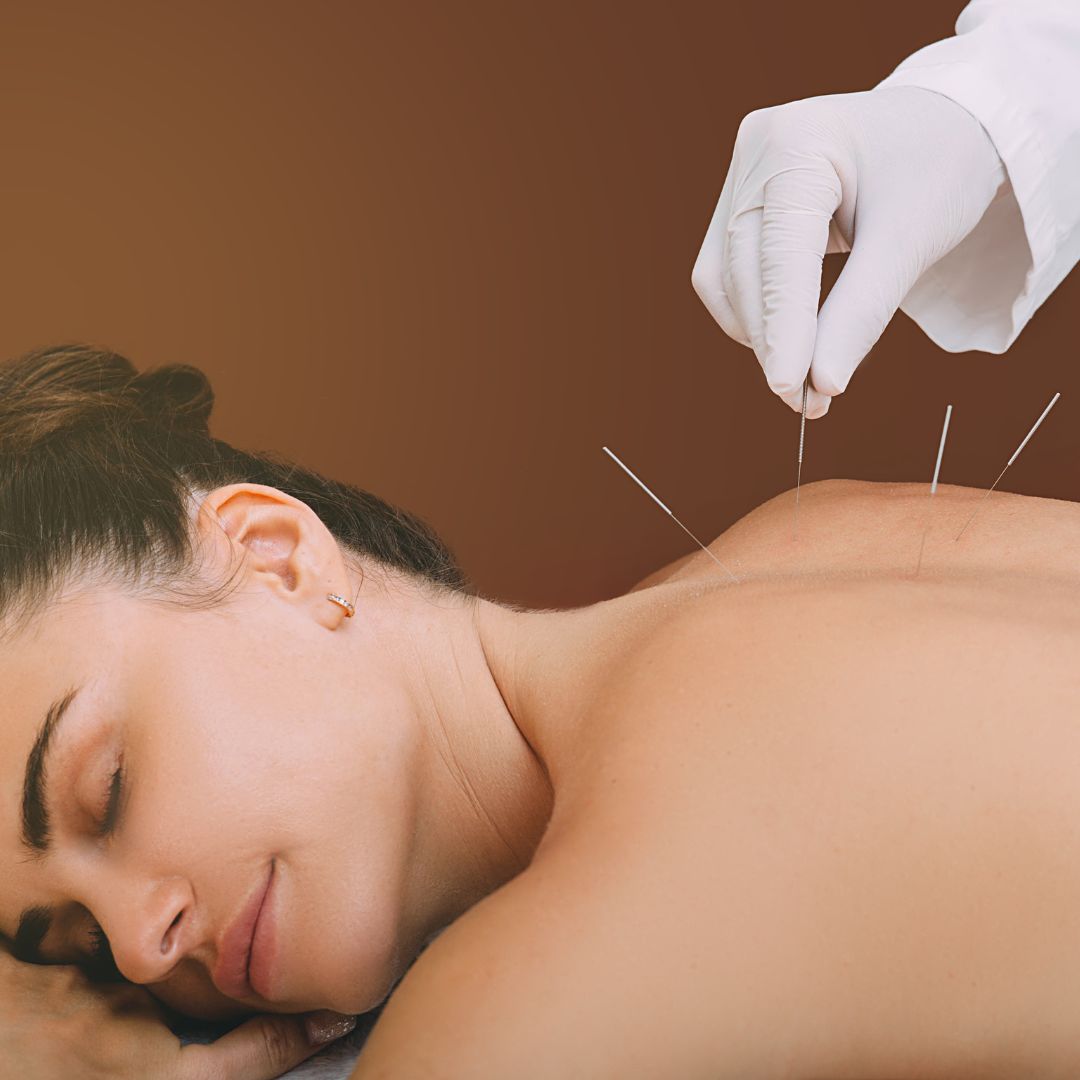 Woman looking relaxed getting acupuncture in her back. 