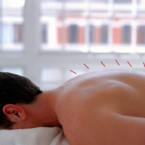 man getting acupuncture